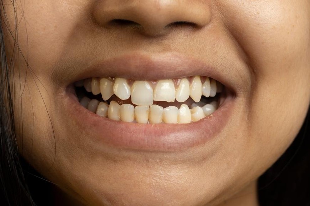 Kaj pomeni, če imate krive zobe? (foto: shutterstock)