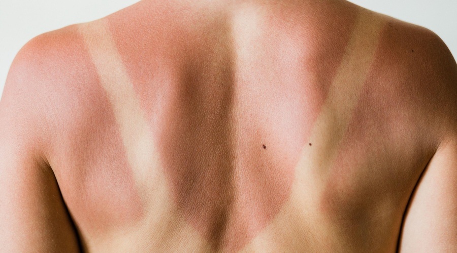 Naravni načini za zdravljenje sončnih opeklin (svetujejo dermatologi) (foto: Profimedia)